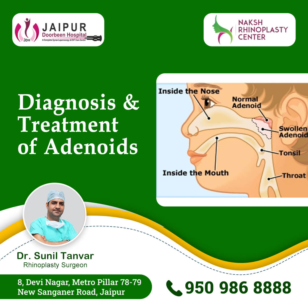 Adenoids - Diagnosis & Treatment