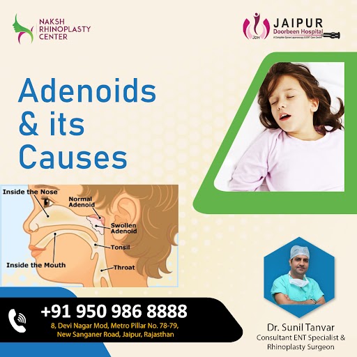 What is Adenoids and It's Major Causes