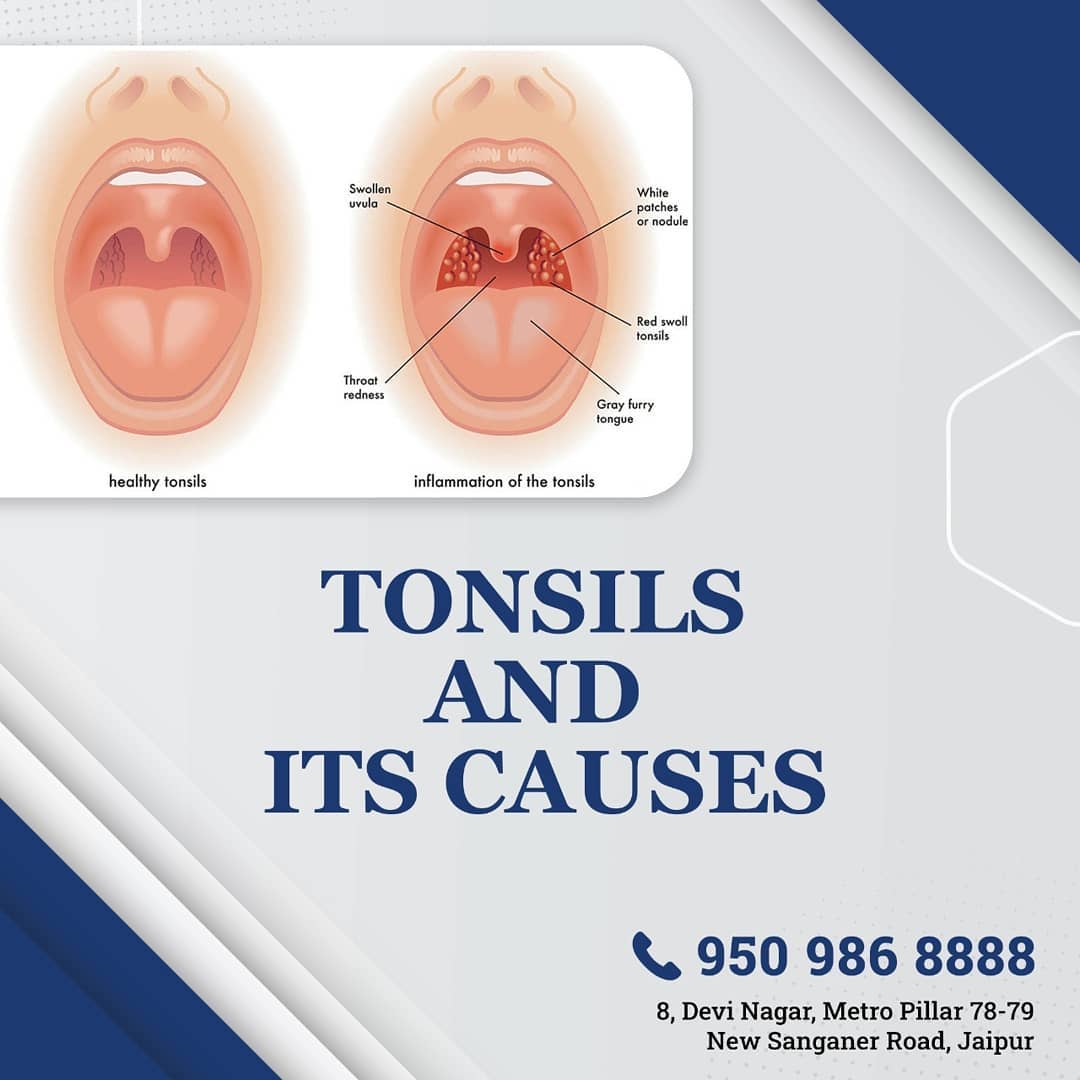 Tonsils and its Causes