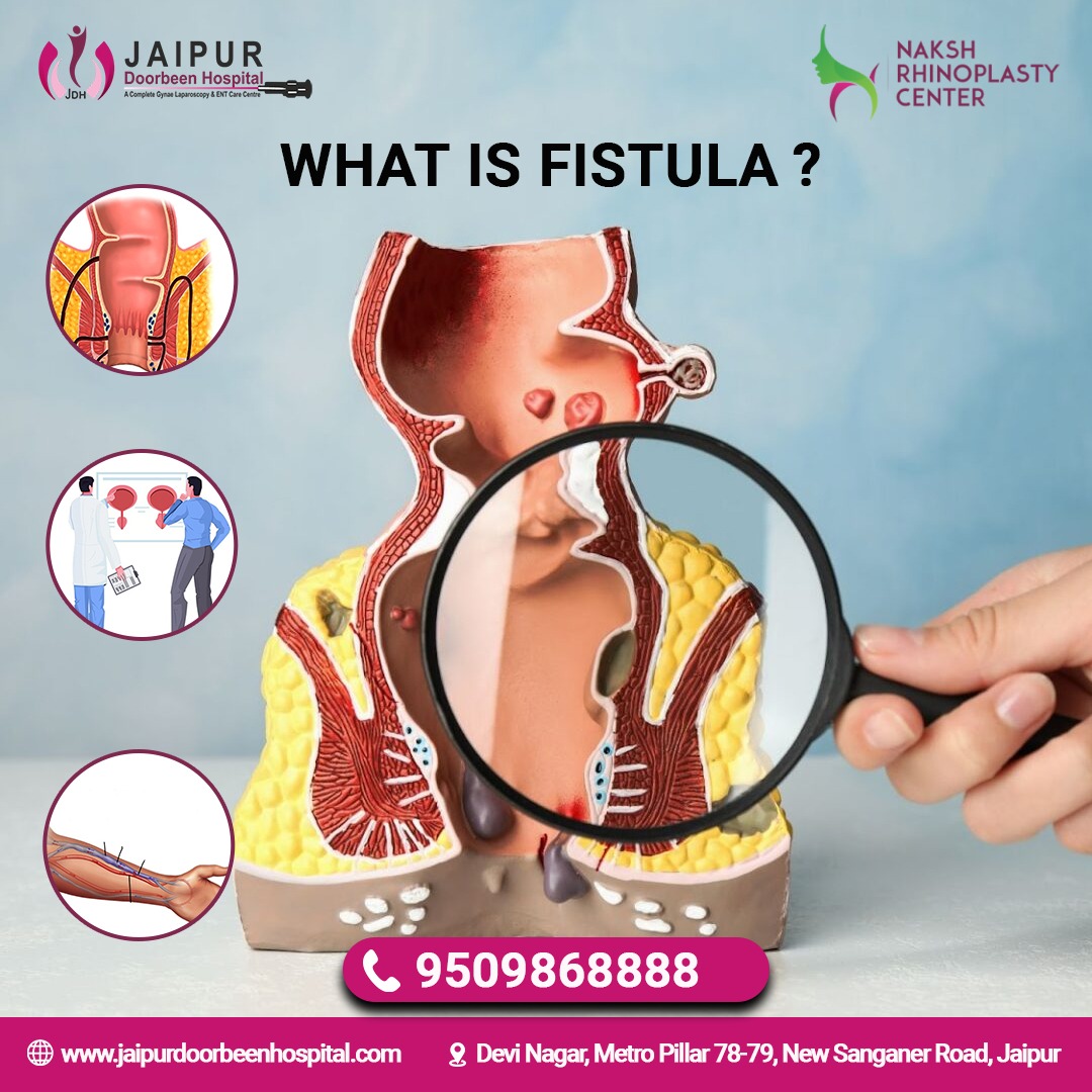 What is a fistula? - Causes and Types