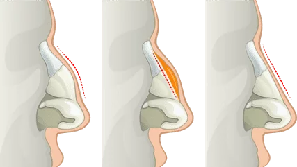 hysterectomy